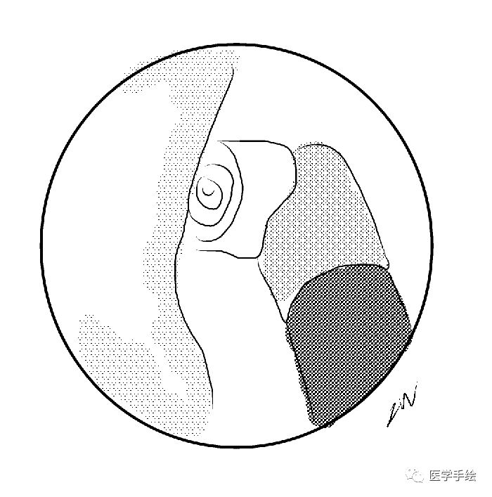 图文结合：单侧双通道内镜技术（UBE）原来没这么难！