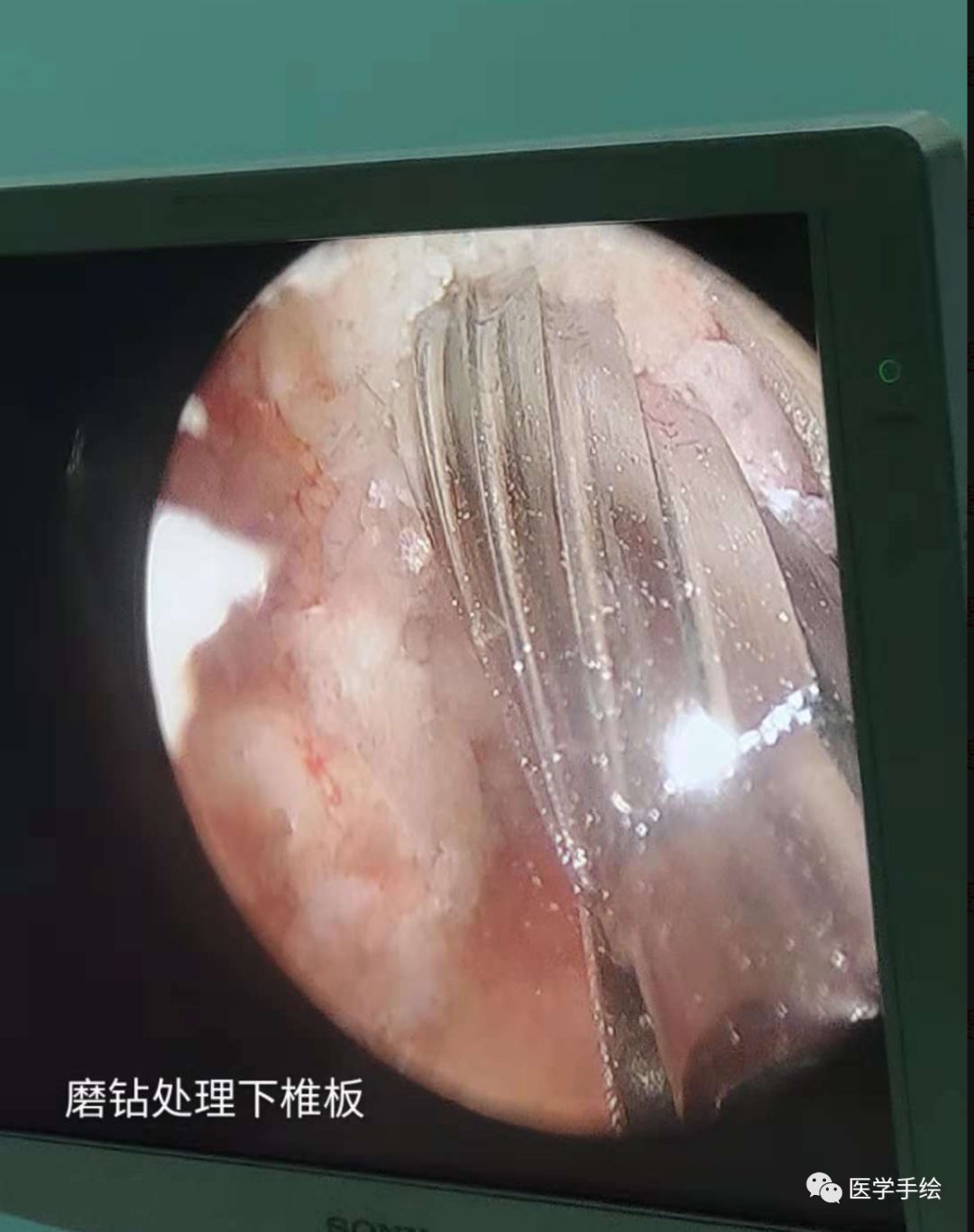 图文结合：单侧双通道内镜技术（UBE）原来没这么难！