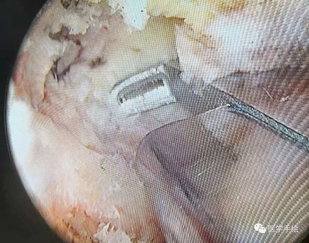 图文结合：单侧双通道内镜技术（UBE）原来没这么难！