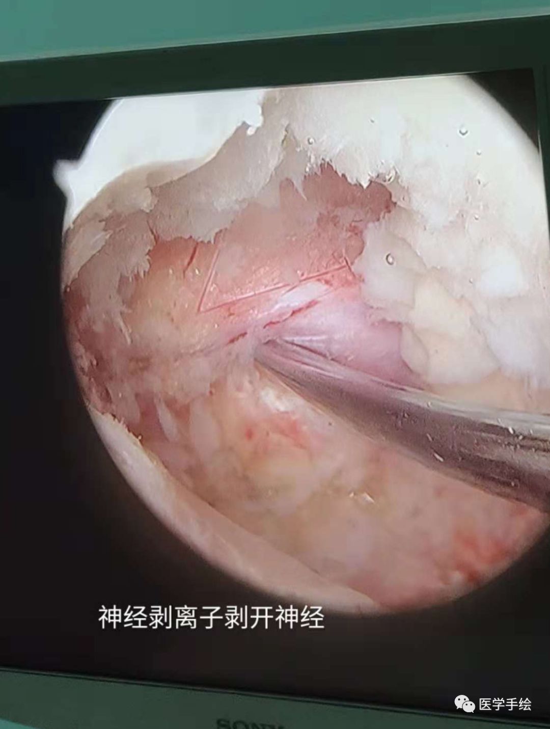 图文结合：单侧双通道内镜技术（UBE）原来没这么难！