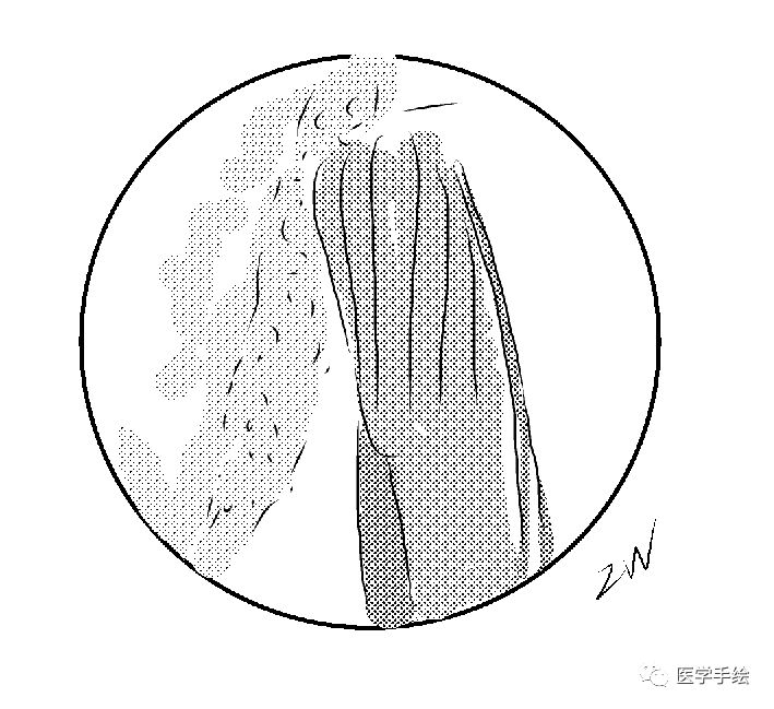 图文结合：单侧双通道内镜技术（UBE）原来没这么难！