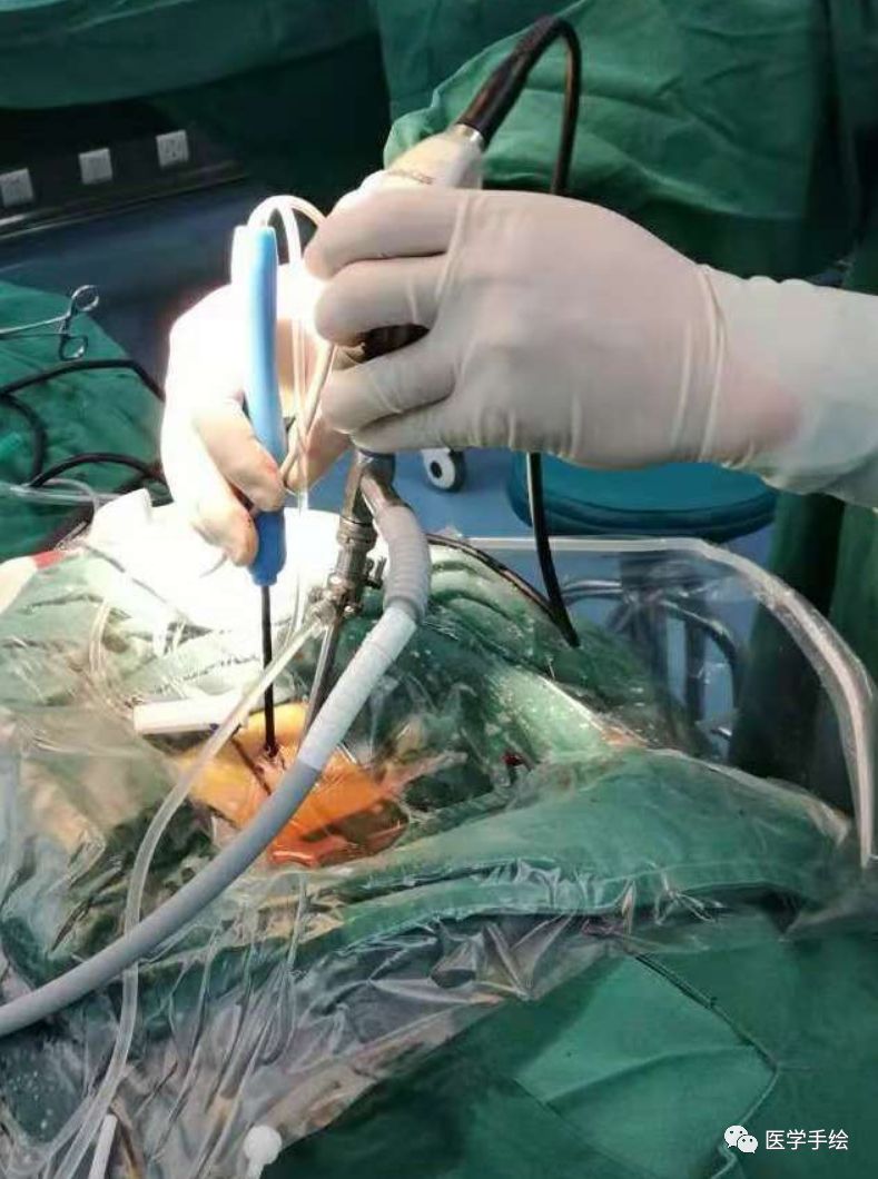 图文结合：单侧双通道内镜技术（UBE）原来没这么难！
