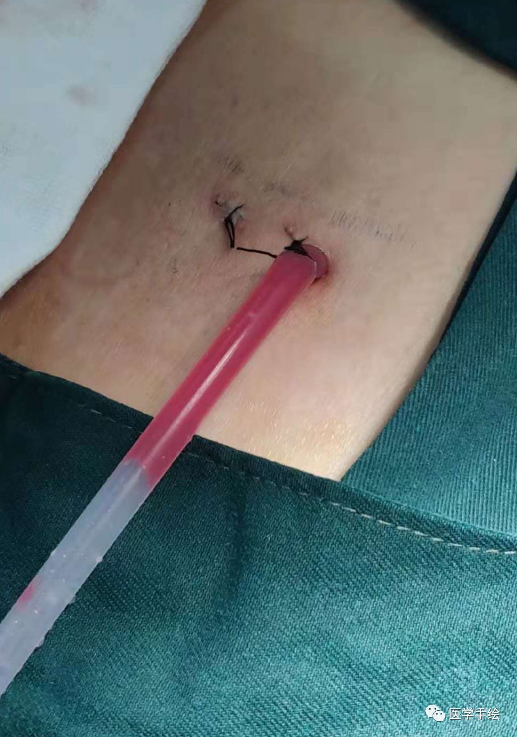 图文结合：单侧双通道内镜技术（UBE）原来没这么难！