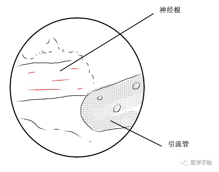 图文结合：单侧双通道内镜技术（UBE）原来没这么难！