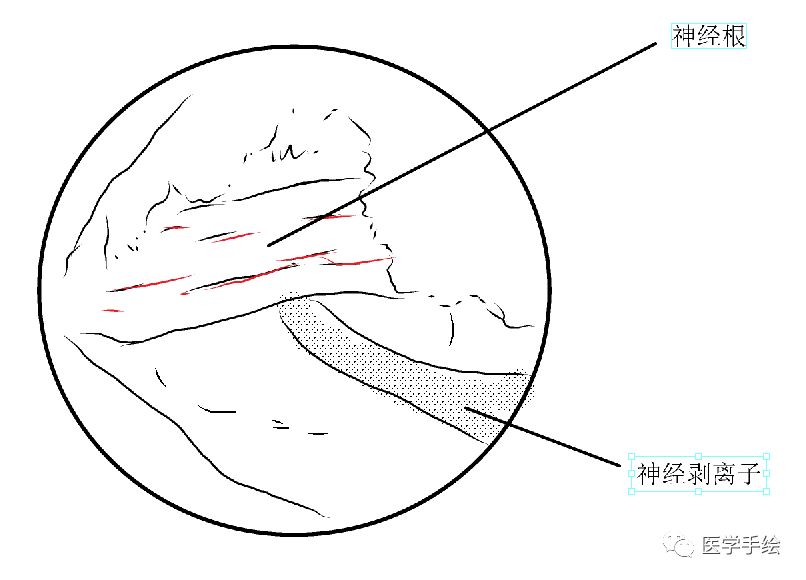 图文结合：单侧双通道内镜技术（UBE）原来没这么难！