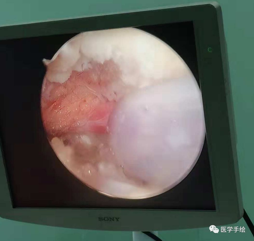 图文结合：单侧双通道内镜技术（UBE）原来没这么难！