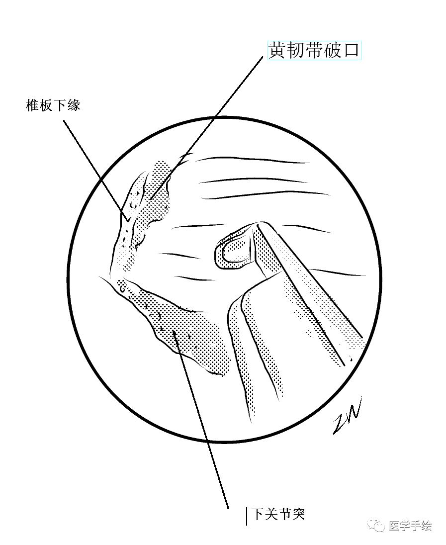 图文结合：单侧双通道内镜技术（UBE）原来没这么难！