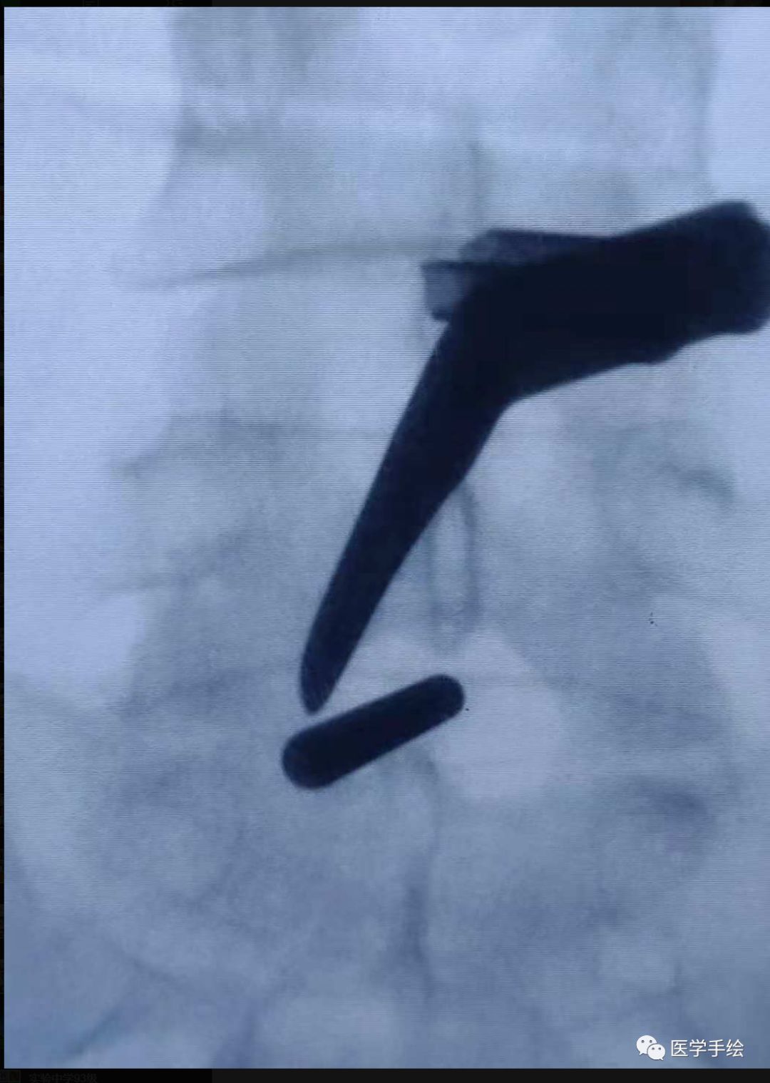 图文结合：单侧双通道内镜技术（UBE）原来没这么难！