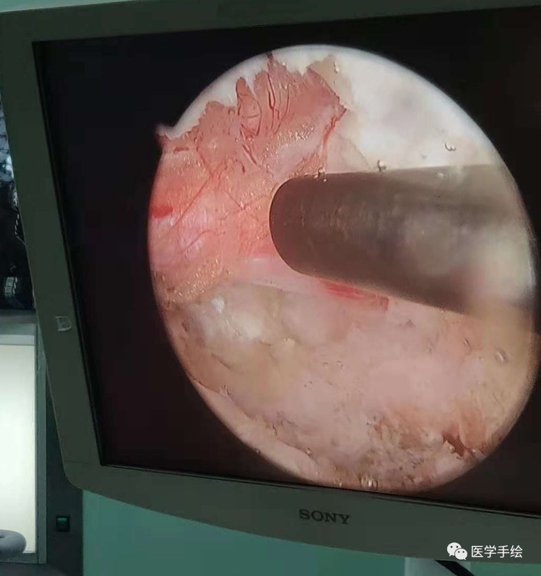 图文结合：单侧双通道内镜技术（UBE）原来没这么难！