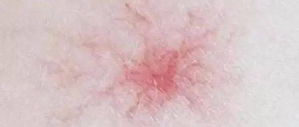 身上突然出现小红点，别不当回事！可能是大病的预警信号！