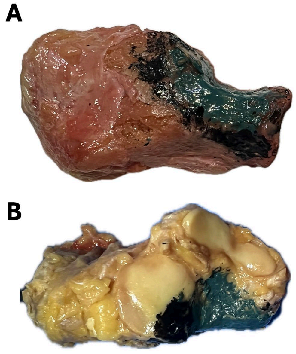 改良跗骨窦入路的优势有哪些？