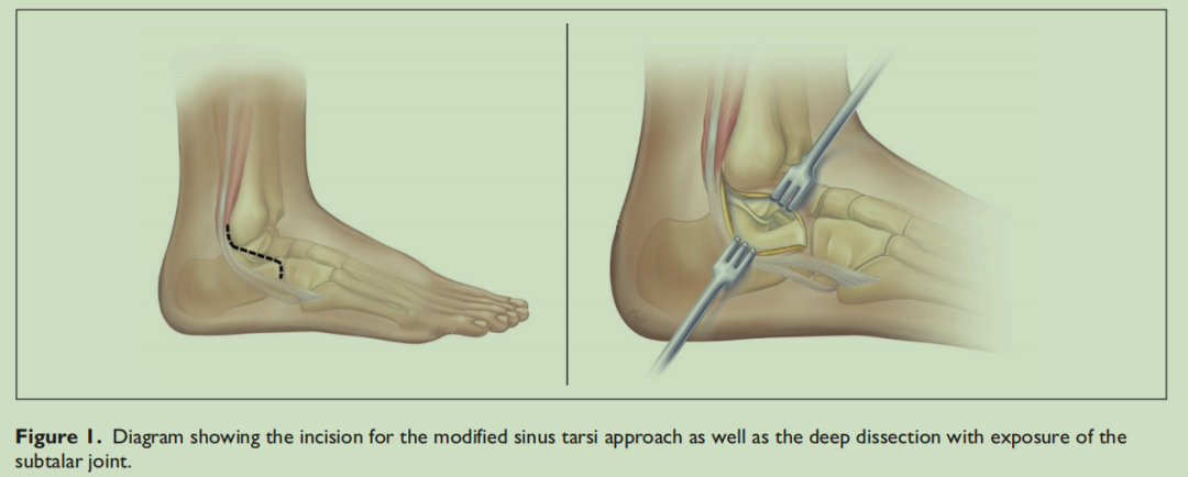 改良跗骨窦入路的优势有哪些？