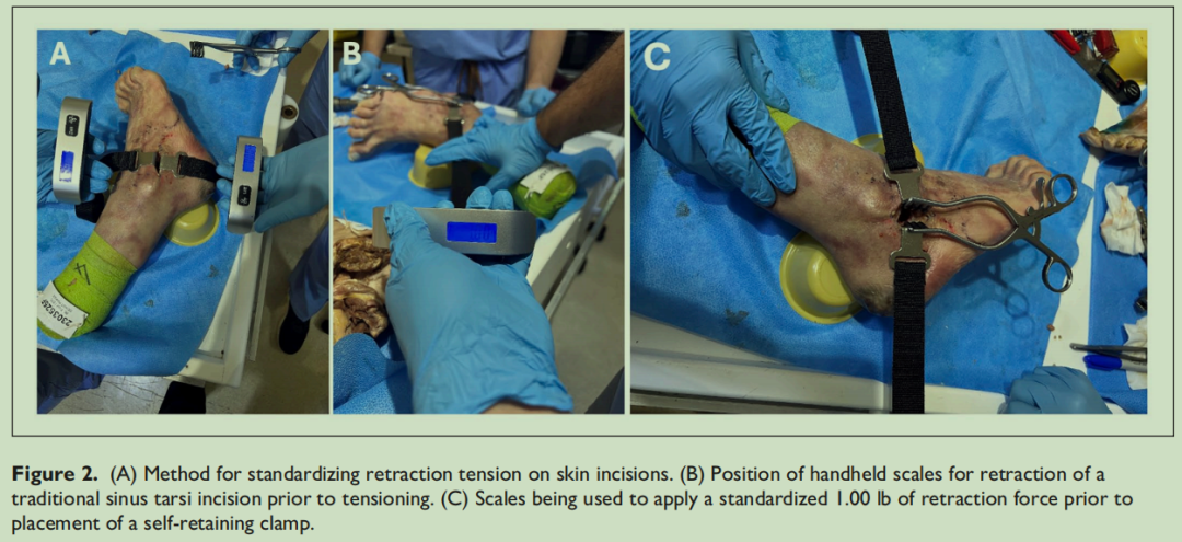 改良跗骨窦入路的优势有哪些？