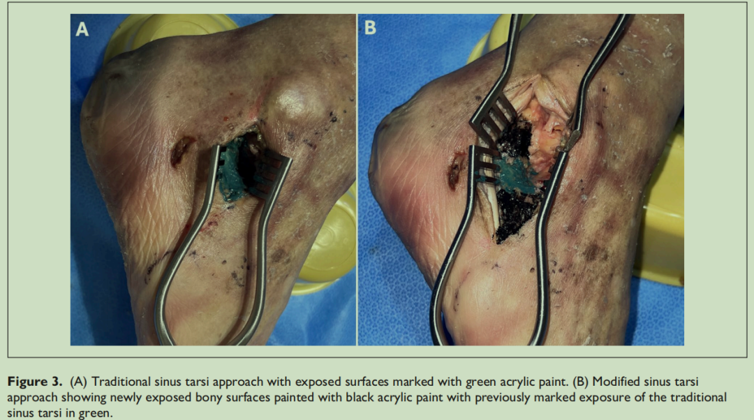 改良跗骨窦入路的优势有哪些？