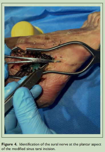 改良跗骨窦入路的优势有哪些？