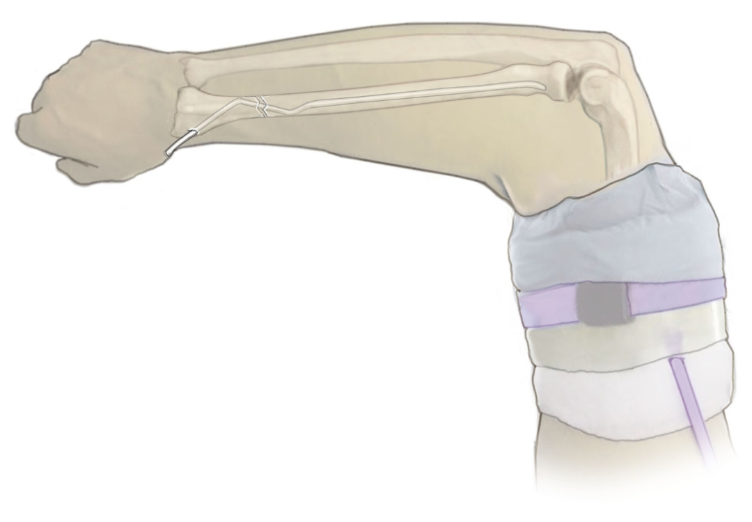 【手术技巧】不仅仅是微创：弹性髓内钉如何应对儿童桡骨骨折的“不稳定”挑战？