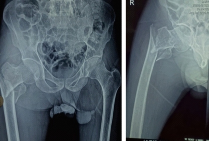 罕见病例介绍：合并外周血管疾病的股骨粗隆间骨折术后出现急性肢体缺血导致截肢。