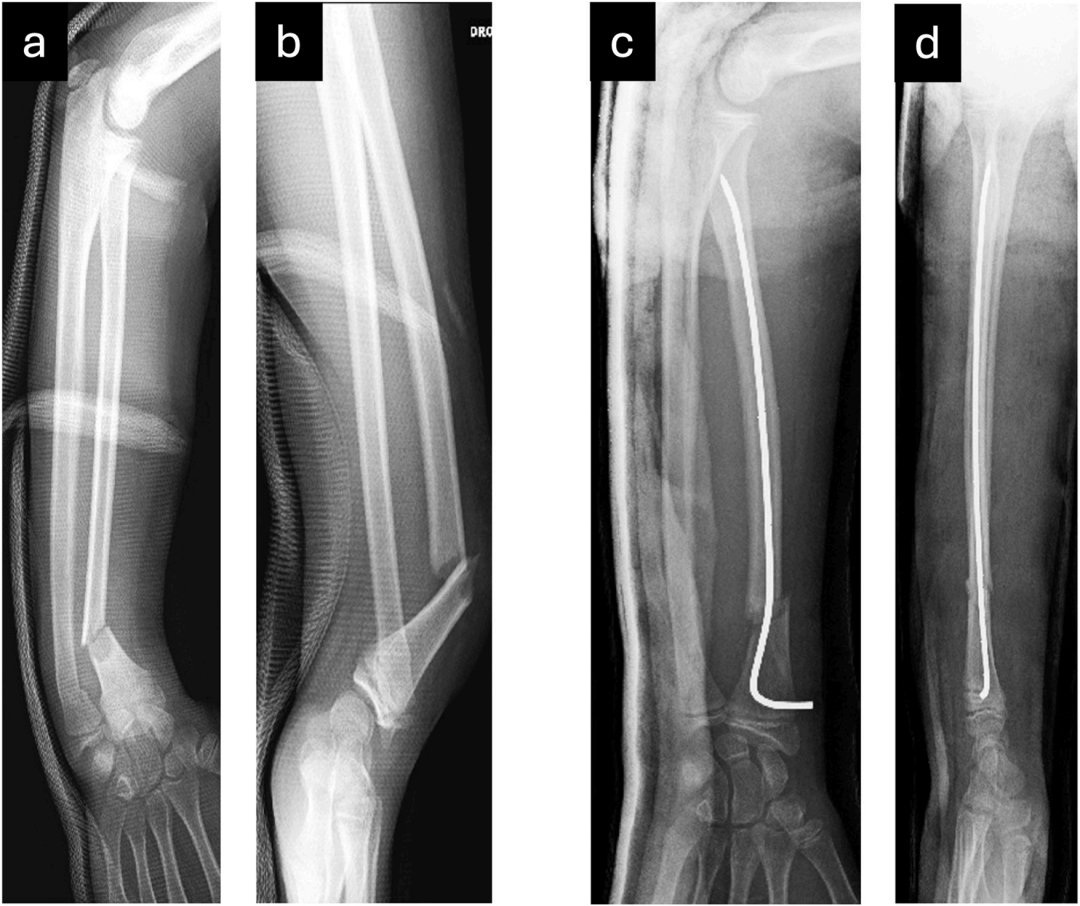 【手术技巧】不仅仅是微创：弹性髓内钉如何应对儿童桡骨骨折的“不稳定”挑战？