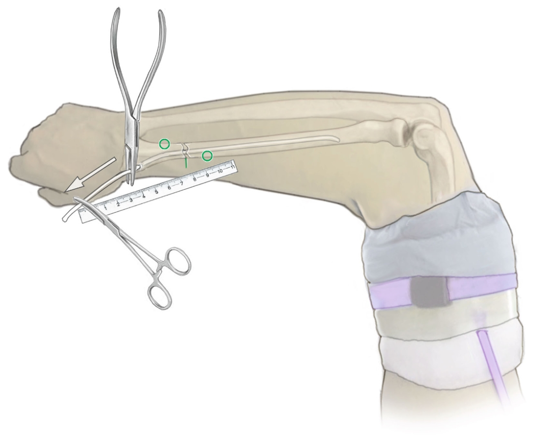 【手术技巧】不仅仅是微创：弹性髓内钉如何应对儿童桡骨骨折的“不稳定”挑战？