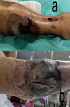 罕见病例介绍：合并外周血管疾病的股骨粗隆间骨折术后出现急性肢体缺血导致截肢。