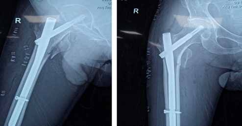 罕见病例介绍：合并外周血管疾病的股骨粗隆间骨折术后出现急性肢体缺血导致截肢。