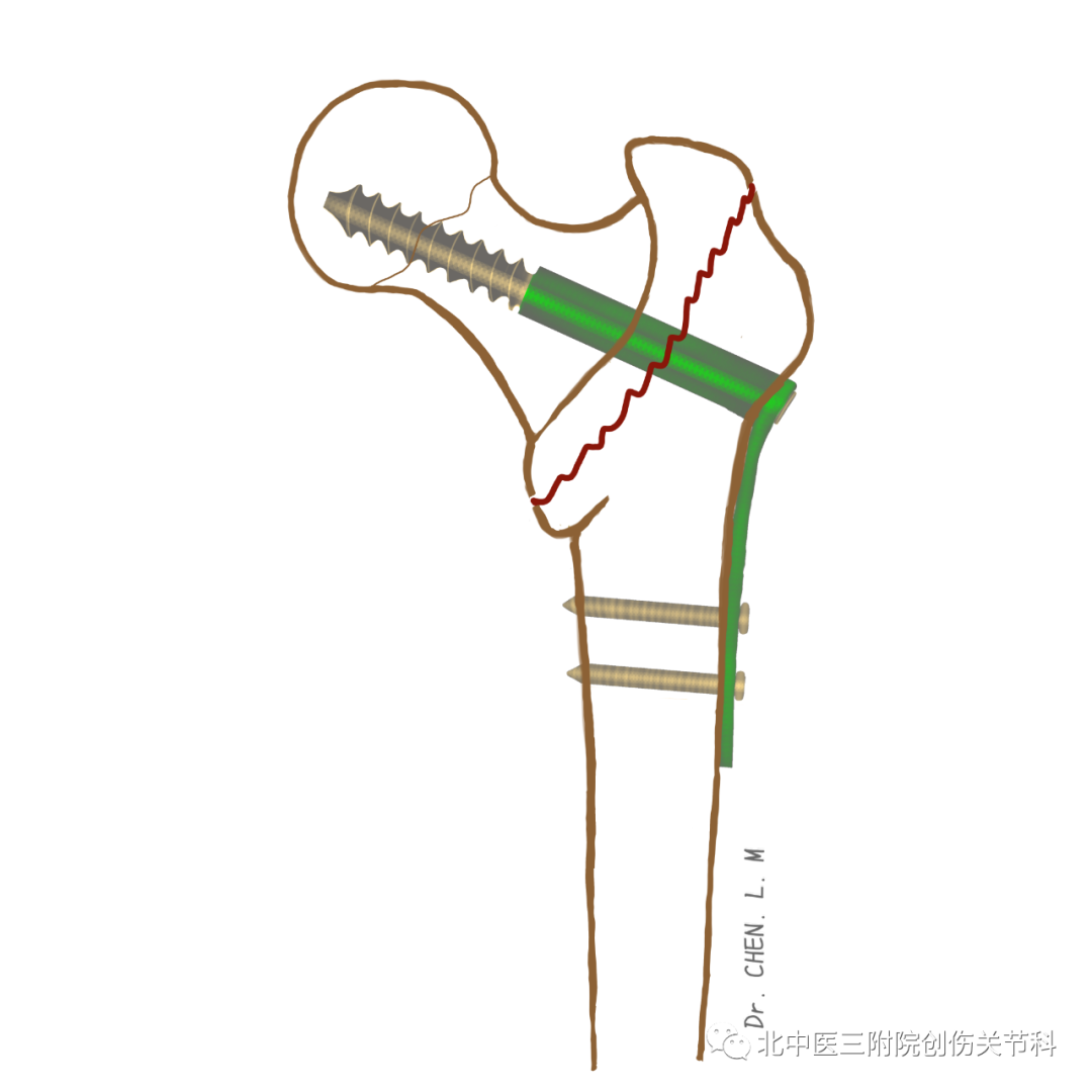 股骨粗隆间骨折的分型与临床诊治
