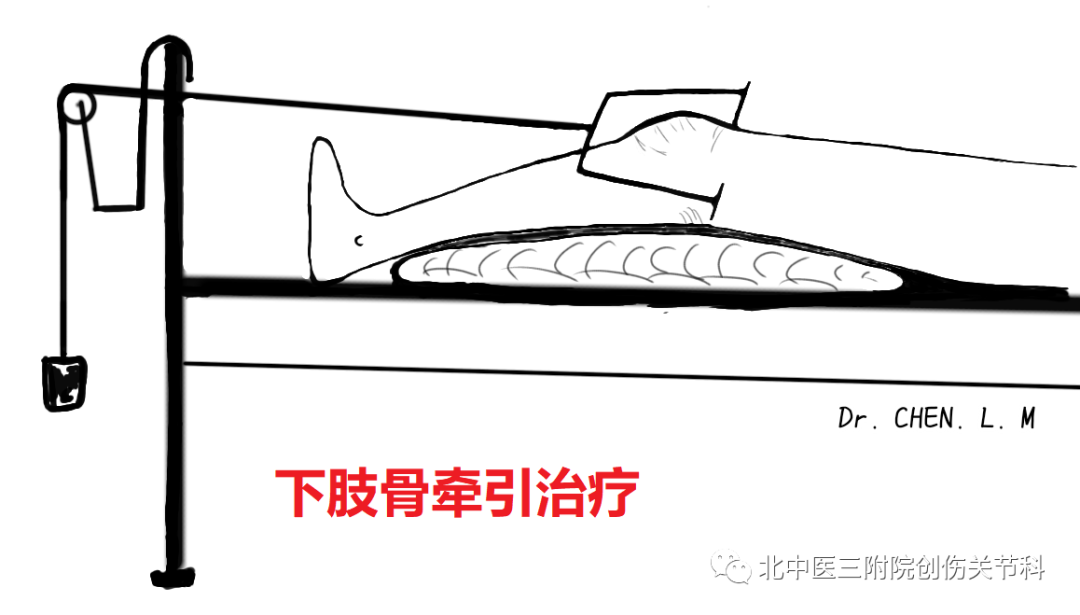 股骨粗隆间骨折的分型与临床诊治