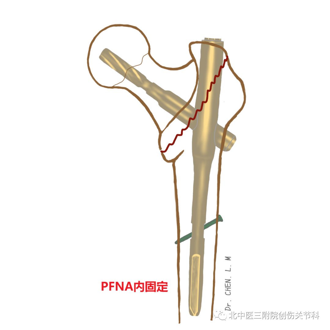 股骨粗隆间骨折的分型与临床诊治