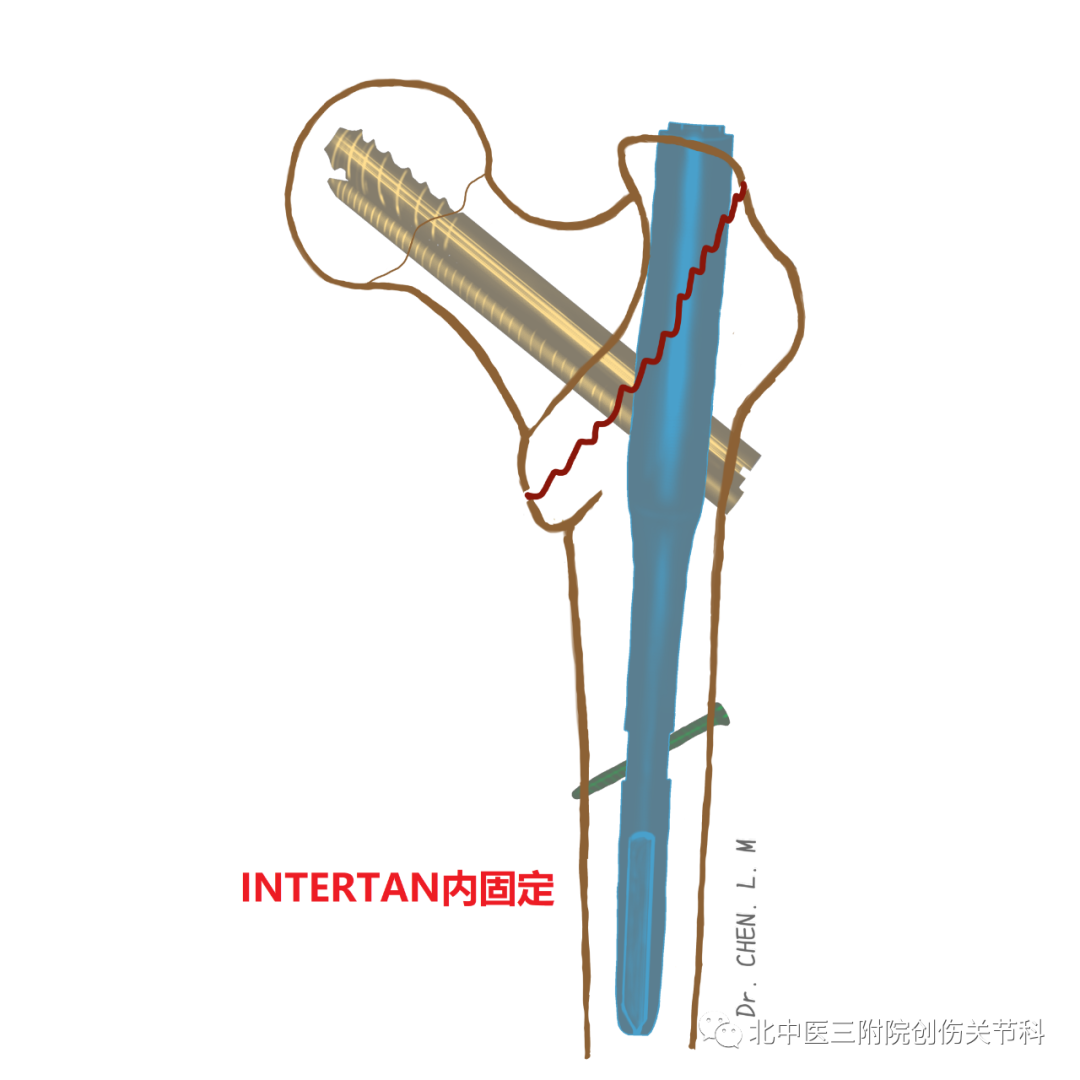 股骨粗隆间骨折的分型与临床诊治