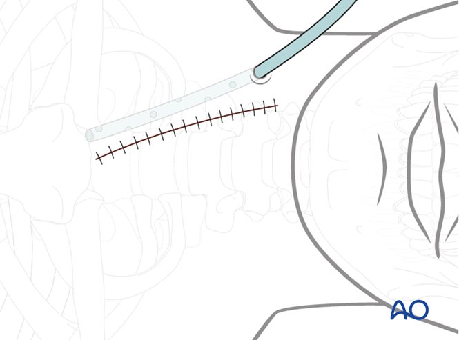 颈椎前路怎么做？让AO来教你