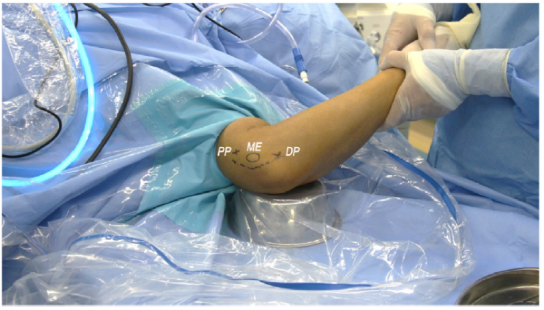 全关节镜下尺神经松解并皮下前置术