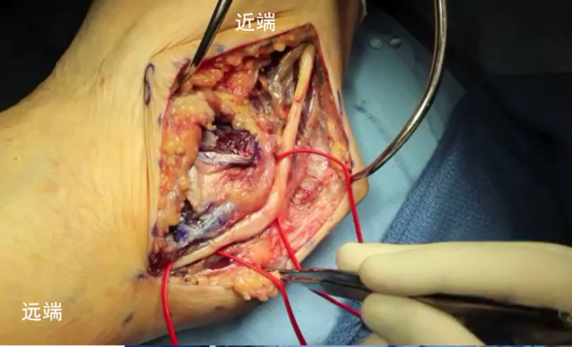 全关节镜下尺神经松解并皮下前置术