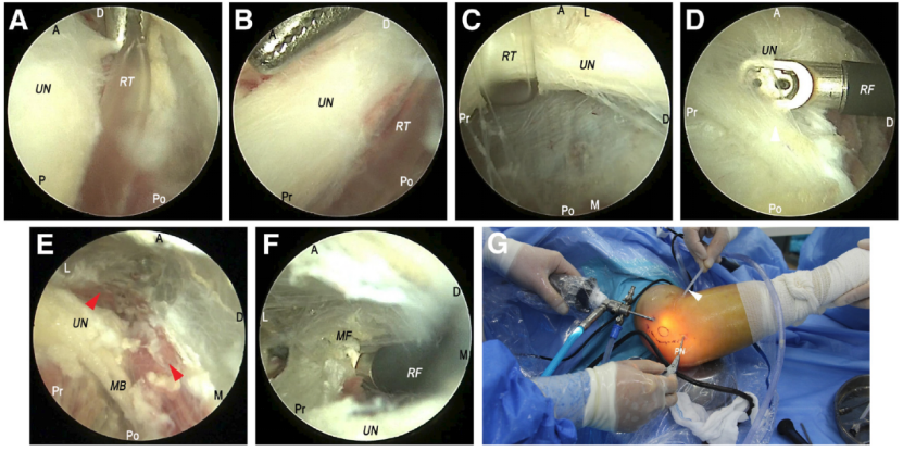 全关节镜下尺神经松解并皮下前置术