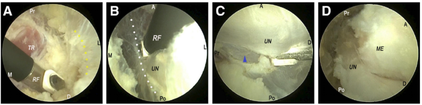 全关节镜下尺神经松解并皮下前置术