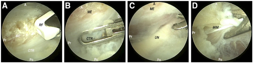 全关节镜下尺神经松解并皮下前置术