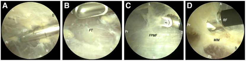 全关节镜下尺神经松解并皮下前置术