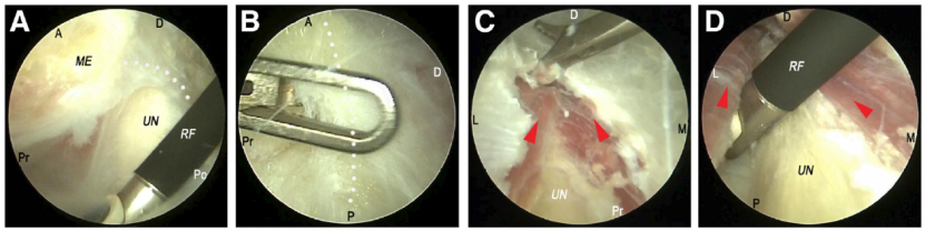 全关节镜下尺神经松解并皮下前置术