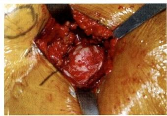 髋关节置换前侧入路DAA入路(改良的Smith-Petersen入路)手术技术详解