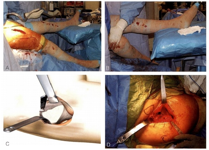 髋关节置换前侧入路DAA入路(改良的Smith-Petersen入路)手术技术详解