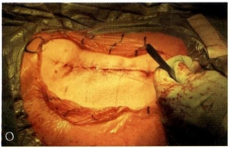 髋关节置换前侧入路DAA入路(改良的Smith-Petersen入路)手术技术详解