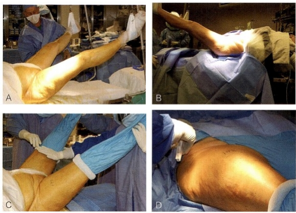 髋关节置换前侧入路DAA入路(改良的Smith-Petersen入路)手术技术详解