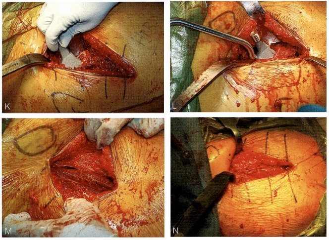 髋关节置换前侧入路DAA入路(改良的Smith-Petersen入路)手术技术详解