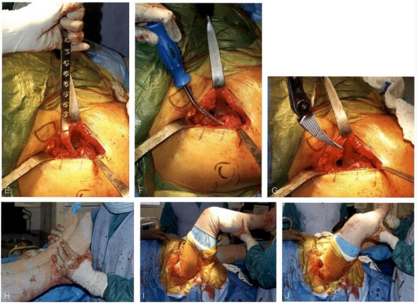 髋关节置换前侧入路DAA入路(改良的Smith-Petersen入路)手术技术详解