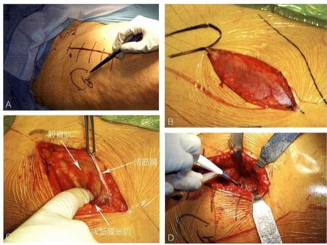 髋关节置换前侧入路DAA入路(改良的Smith-Petersen入路)手术技术详解