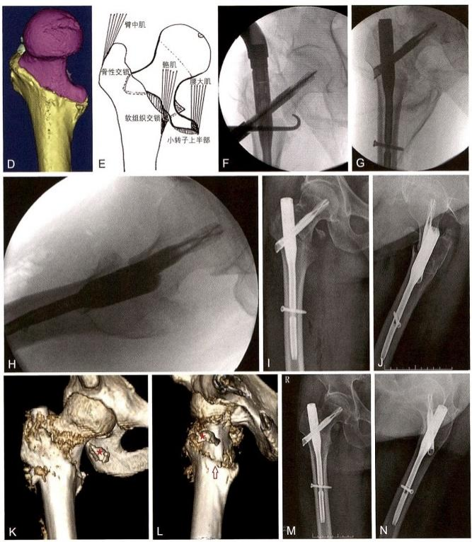 股骨粗隆间骨折的髓内钉手术治疗技术