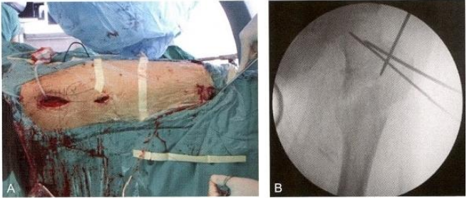 股骨粗隆间骨折的髓内钉手术治疗技术