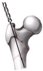 股骨粗隆间骨折的髓内钉手术治疗技术