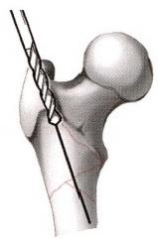 股骨粗隆间骨折的髓内钉手术治疗技术