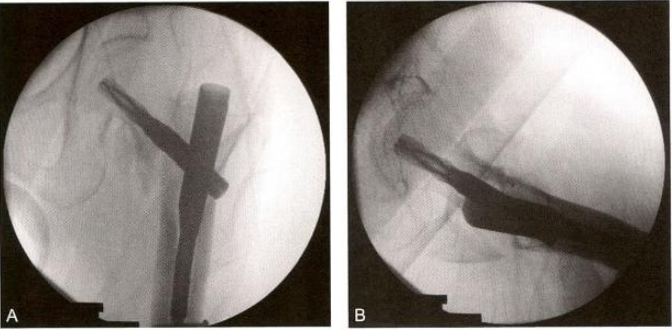 股骨粗隆间骨折的髓内钉手术治疗技术