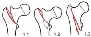 股骨粗隆间骨折的髓内钉手术治疗技术